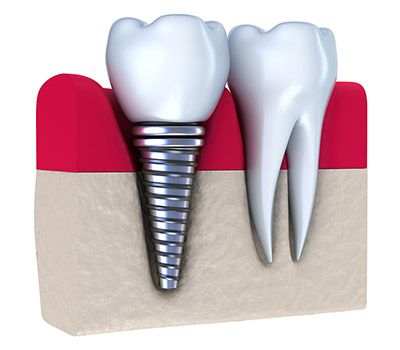 Implants Implants